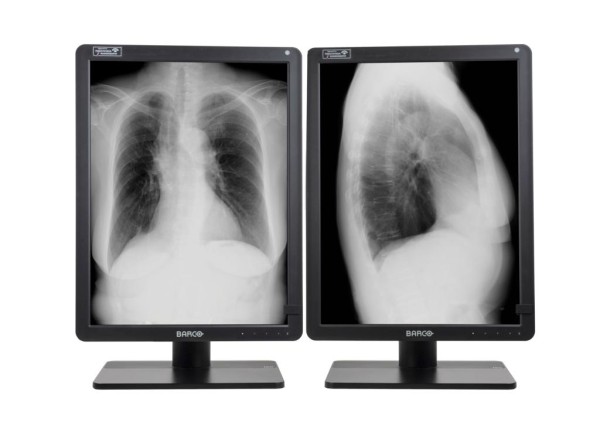 Mammographie Display Barco Nio Gray 5,8 MP Graustufen-Display